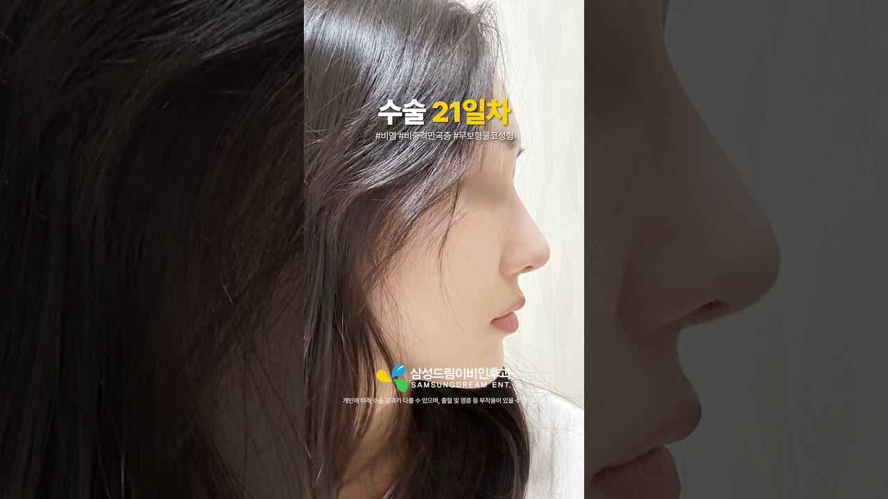 여자 무보형물코성형 한달 후기👍 #shorts #비염수술 #비중격만곡증수술 #코성형 #비밸브재건술 #여자코성형 #코성형브이로그 #코성형후기 #코성형전후 #무보형코성형
