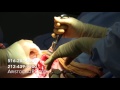 Implant Exchange and Capsulectomy with Dr. Tehrani