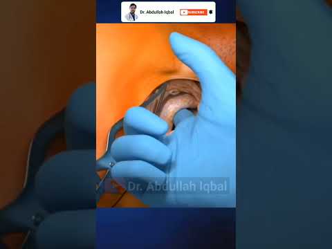 Hernia Surgery 3D Animation #shorts