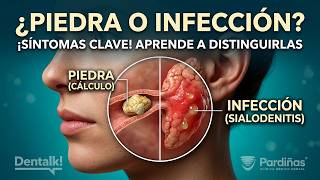 ¿Cálculo salival o infección? Aprende a identificar los síntomas - Paperas