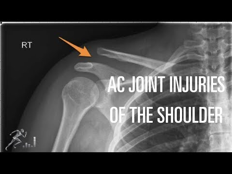 Diät für Osteoarthritis des Knies Video Schmerzen im unteren Rücken auf der linken Seite gibt auf