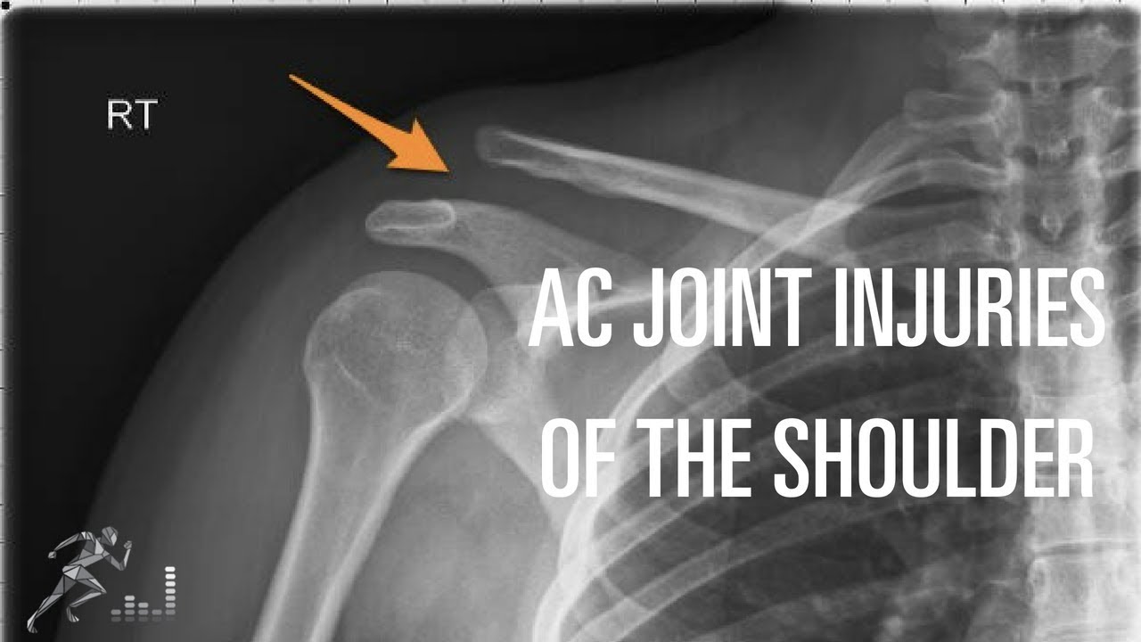 Acromioclavicular (AC) joint injury: Mechanism of injury, diagnosis and treatment