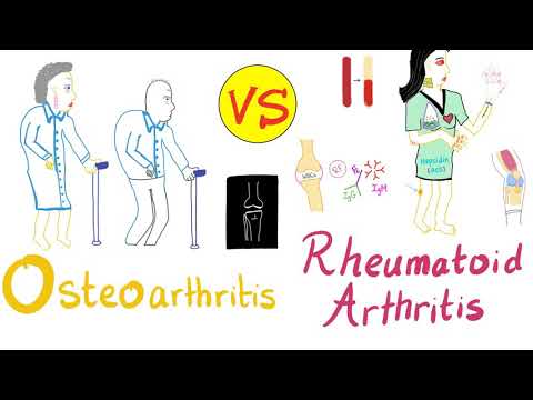 discus compositum a térd osteoarthritisében