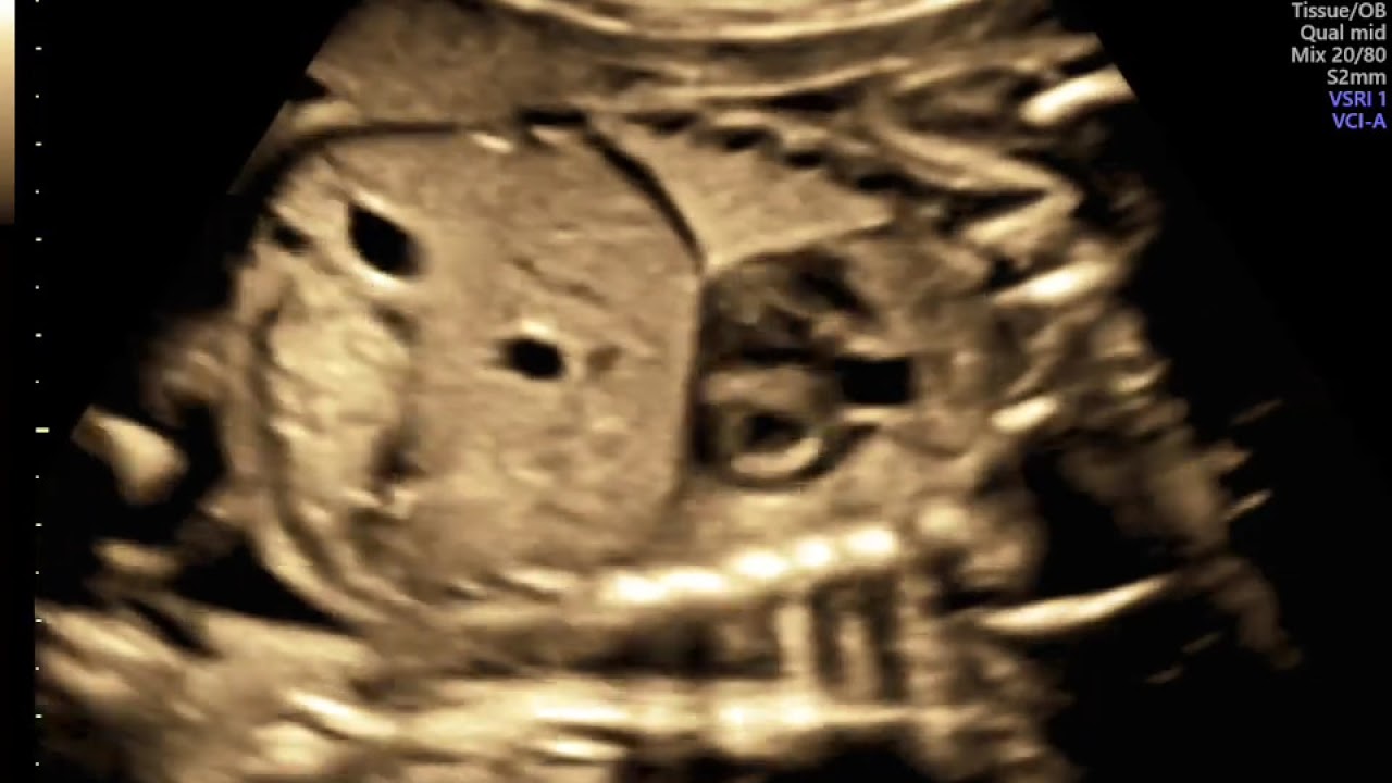 ECOGRAFIA DO CORAÇÃO FETAL 2
