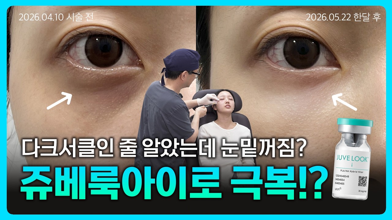 눈밑에 효과적인 쥬베룩 아이, 눈밑 꺼짐과 다크서클이 고민일 때 ????