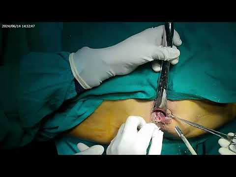 OPB MOLIS combined with cryotherapy operative video