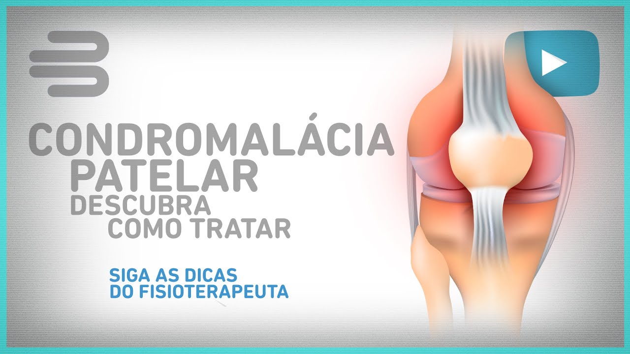 Condromalácia Patelar - O que é, como ocorre, sintomas e como tratar