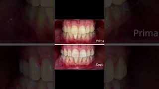 Sbiancamento denti - prima/dopo