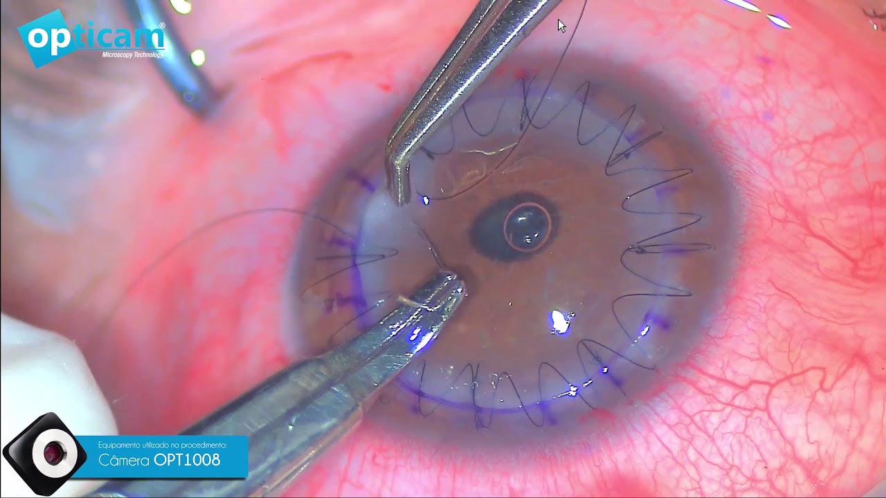 Transplante de CÓRNEA - Câmera Opticam