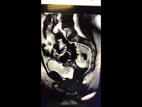 Cystocele - Pelvis MRI