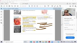 GIT 9-B- Intestinal obstruction -- Ibrahem Gamal -Toxic usmle - شرح المعادلة الامريكية بالعربي