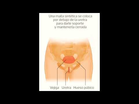 Cirugía Incontinencia Urinaria
