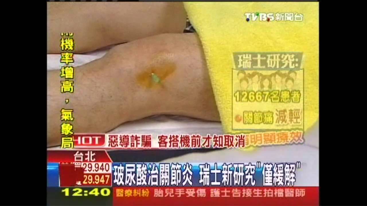 玻尿酸治關節炎 瑞士新研究「僅緩解」