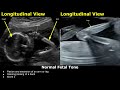 Fetal Biophysical Profile Ultrasound Normal Vs Abnormal Values Fetus Breathing Tone BPS BPP USG