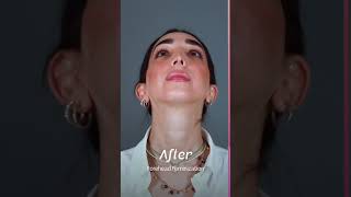 ❤️ Lola beautiful post-op results of her #ForeheadFeminization #Surgery