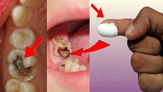 How To Get Rid Of Tooth Cavity Whiten Your Teeth at Home Naturally