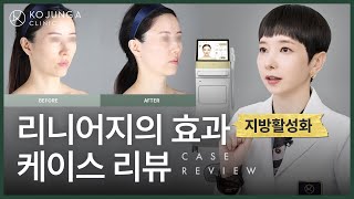 선타입의 빈틈없는 리프팅. 리니어지의 지방활성화 효과는?