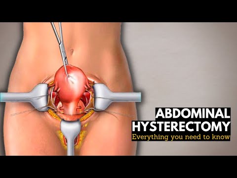 Abdominal Hysterectomy: Everything You Need to Know
