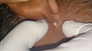 Small pus popping