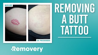 Removing a Butt Cheek Tattoo | Motivation Monday