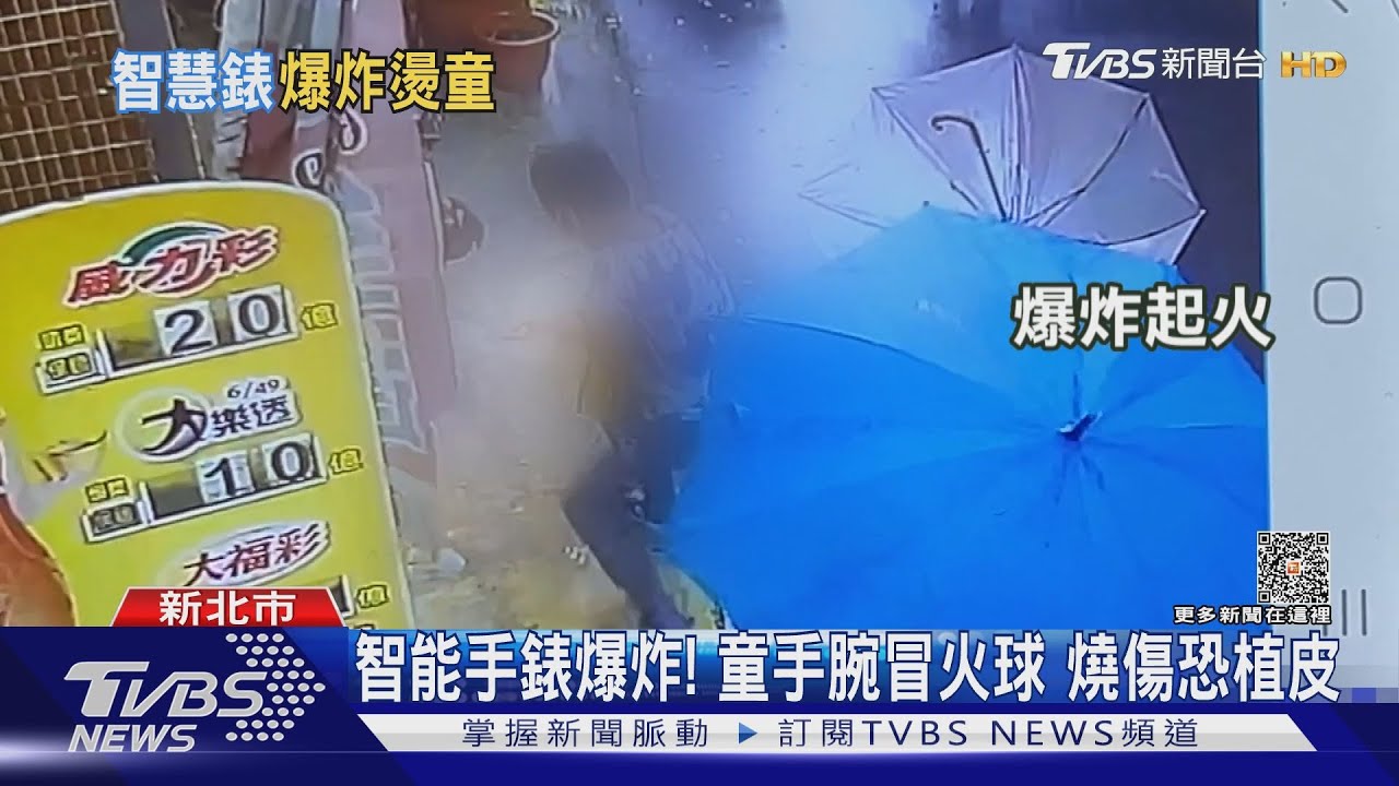 智能手錶爆炸! 童手腕冒火球燒傷恐植皮