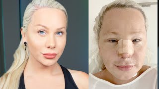 I had Facial Feminisation Surgery (One year update)