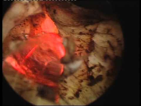 Trattamento di prostatite radon N con un adenoma prostatico