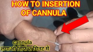 How to insert the cannula?, Cannulation कैसे करे, intravenous (iv) cannula 