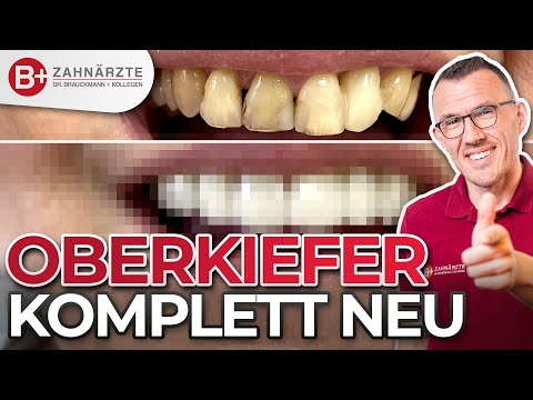Oberkiefer Makeover mit Brücken und Kronen als Versorgung - Top Vorher/Nachher-Ergebnis!