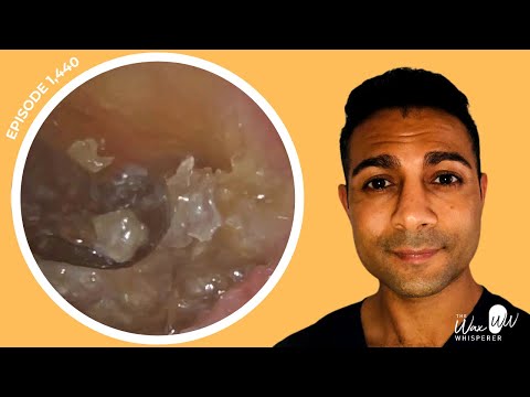 1,440 - Rock Solid Painful Grade III Keratosis Obturans Removal Worsened by Cotton Swab Misuse