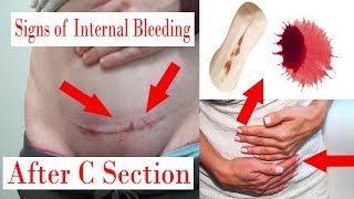 7 Common Signs of Internal Bleeding After a C Section!