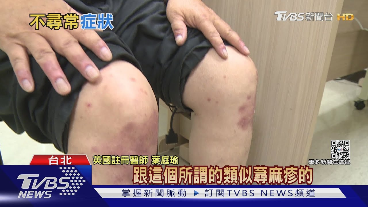 新冠還有「這四種」不尋常症狀! 台灣「這時」湧現後遺症病人