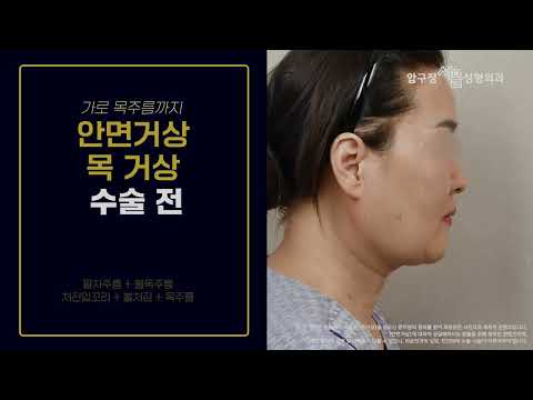 #안면거상 #목거상 더이상 목주름 안 가려도 됩니다.