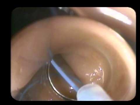 Uszypułowany polip w jelicie grubym - ligacja pętlowa z endoskopią typu cap-assisted