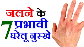 जलने पर करिए ये घरेलू नुस्खे Health Tips in Hindi For Burn Treatment - Sonia Goyal - MEN
