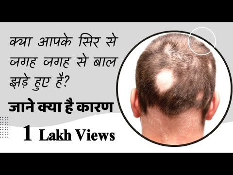 क्या आपके सिर से जगह जगह से बाल झड़े हुए है जाने क्या है कारण  | Alopecia Areata Treatment |