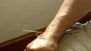preview picture of video 'accupuncture 4 Prostate'