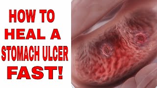 How to Heal a Stomach Ulcer Fast (How to Fix a Stomach Ulcer)