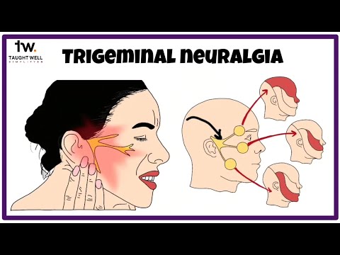 All You Should Know About Trigeminal Neuralgia