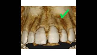 Treatment of multiple lesions nonsurgically