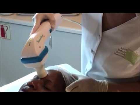 Peeling di una faccia in salone di una lentiggine Cambiamento di pigmentazione di pelle al sole