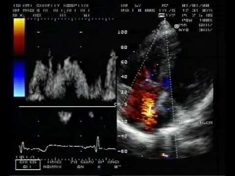 Ostium Secundum Atrial Septal Defect And Perimembranous Ventricular Septal Defect