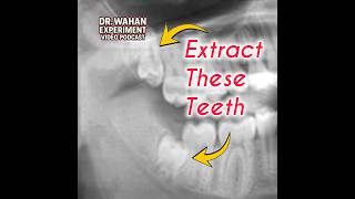 Wisdom Teeth Extractions with Dr. Wahan