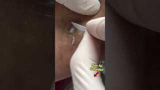 Glass in Foot Leads to Massive Corn Removal! | Podiatry ASMR
