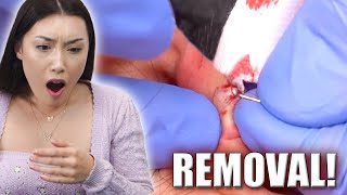 Her Earring Was STUCK For Over a Year!! *Removal*