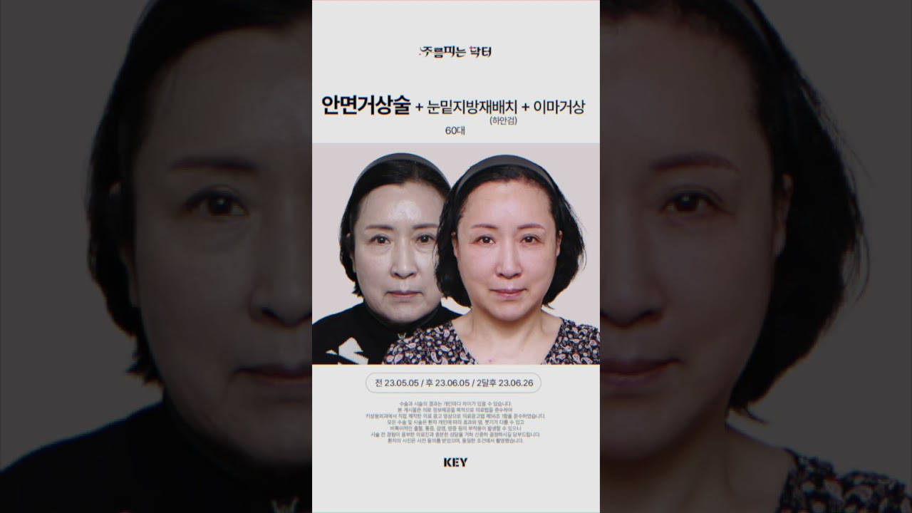 60대의 놀라운 변화 / 눈밑 안면 이마