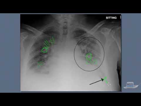 Chest X Ray Interpretation Explained Clearly   3 of 3