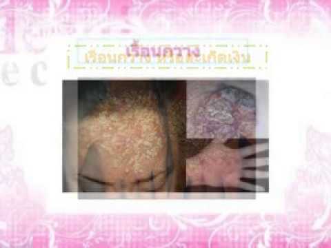 ครีมบนผิวของโรคสะเก็ดเงินจีน โรคสะเก็ดเงินในที่ดี