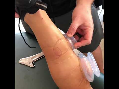 Menard Therapy video.