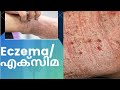 eczema/എക്‌സിമ